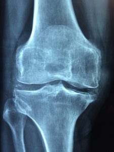 ऑस्टियोपोरोसिस (osteoporosis)